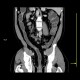 Chronic inflammatory changes of descendent and sigmoid colon: CT - Computed tomography
